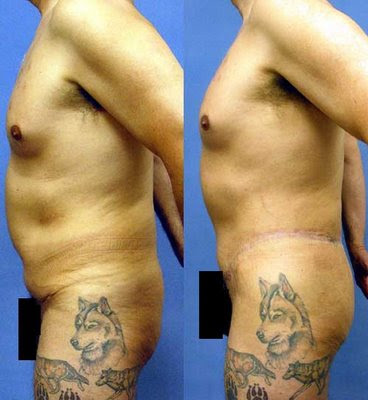 fat injection grafting to buttocks
