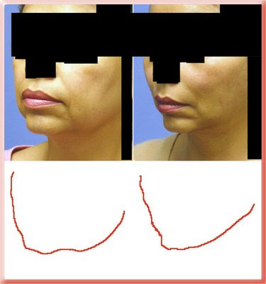 facial contours in the aged and rejuvenated face