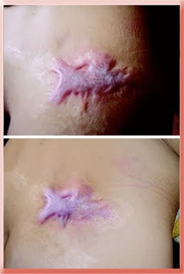hypertrophic scar before and after pressure therapy