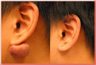 keloid ear