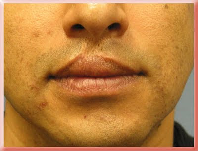 skin loss deficit lip scar
