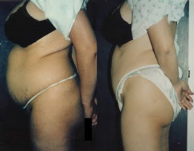 tummy tuck for stretchmarks