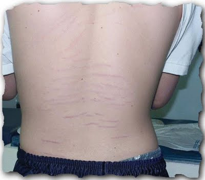 stretchmarks on the back of a teenager