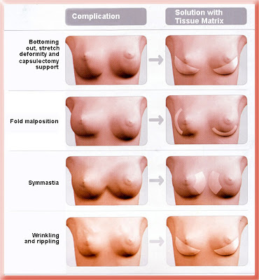breast implant position or rippling problems