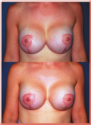 breast implants symmastia synmastia