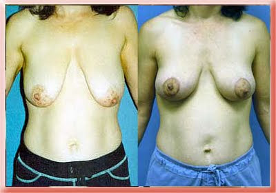 breast lift mastopexy Los Angeles