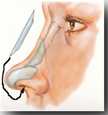 nasal bridge implant