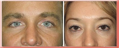 Examples of Tear Trough in Younger Patients Without Protruding Eyelid Fat