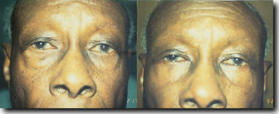 Deeper tear trough after lower eyelid blepharoplasty with fat removal