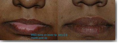vitiligo lip