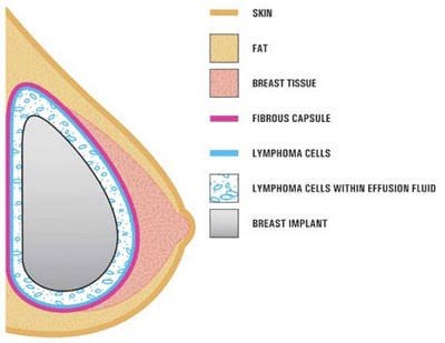 cancer of the breast after breast implant surgery