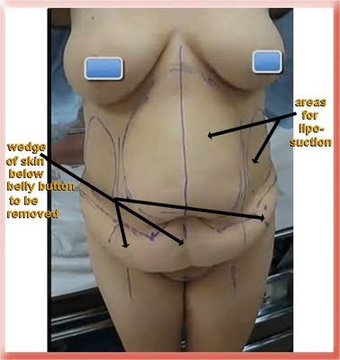 Marking for abdominoplasty tummy tuck