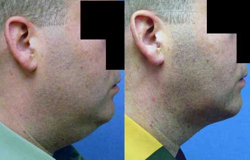 Before and After Neck Liposuction to Remove Double Chin in Los Angeles