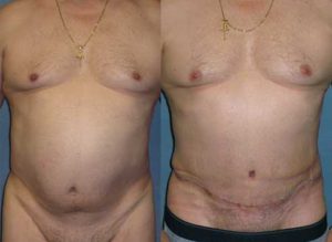 male abdominoplasty tummy tuck