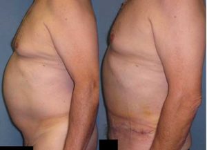 male abdominoplasty tummy tuck