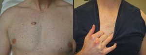 keloid chest
