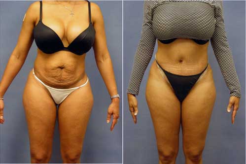 AfroAmerican Abdominoplasty - Tummy Tuck