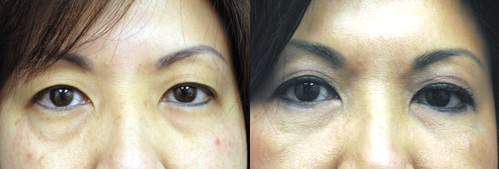 Japanese Asian Upper and Lower Eyelid Surgery Los Angeles