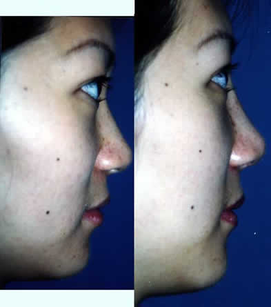 Chinese Asian Rhinoplasty Nose Surgery Los Angeles