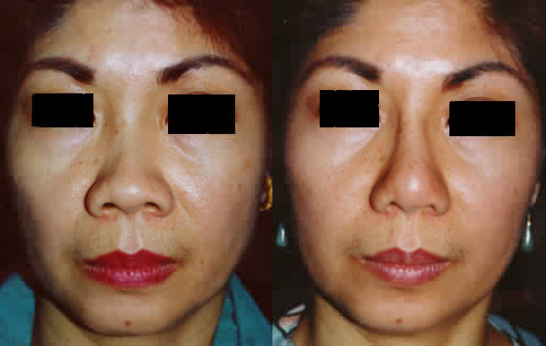 Filipino Asian Rhinoplasty Nose Surgery Los Angeles