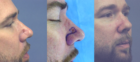 Basal Cell Carcinoma Nose Los Angeles