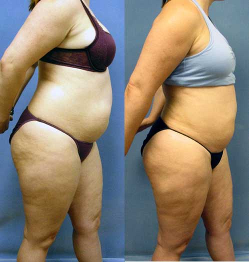 Before and 3 weeks After Liposuction of the Abdomen Stomach Los Angeles