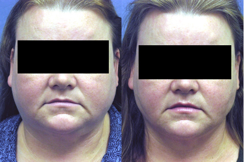 Before and After Redo Liposuction of the Neck in Los Angeles