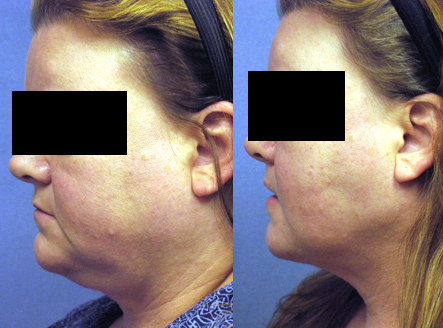 Before and After Redo Liposuction of the Neck in Los Angeles