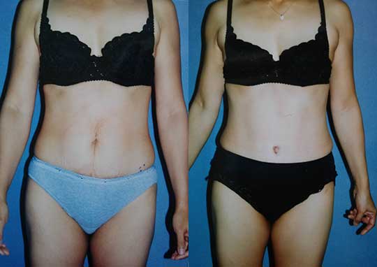 Tummy Tuck - Abdominoplasty Excess Skin Los Angeles