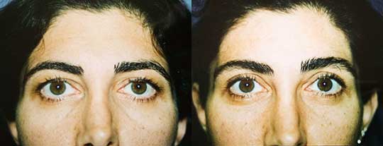 Blepharoplasty Eyelid Surgery Los Angeles