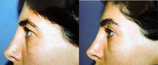 Blepharoplasty Eyelid Surgery Los Angeles