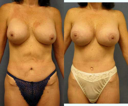 Breast Implant Exchange Removal Capsulectomy Los Angeles