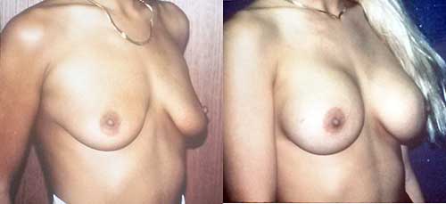 Silicone Gel Breast Implants breast enhancement Los Angeles