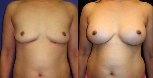 Silicone Gel Breast Implants breast enhancement Los Angeles