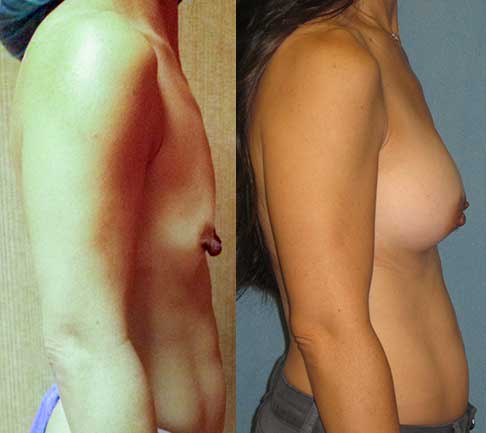 Saline Breast Implants Los Angeles
