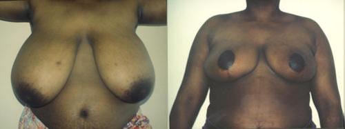 Breast Reduction in Los Angeles