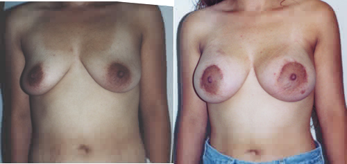 Saline Breast Implants breast enhancement Los Angeles