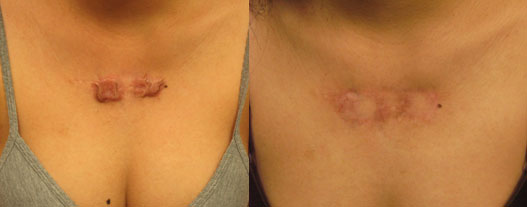 Keloid Chest Los Angeles