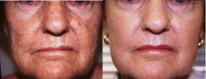 Laser Dermabrasion Skin Resurfacing Wrinkle Removal Los Angeles