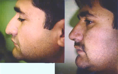 Rhinoplasty Nasal Surgery Nose Job Los Angeles