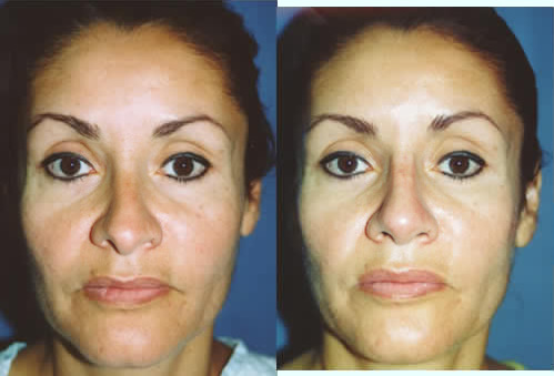 Crooked Nose Deviated Septum Los Angeles