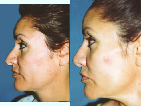 Crooked Nose Deviated Septum Los Angeles