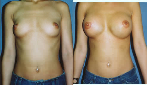 Saline Breast Implants Los Angeles