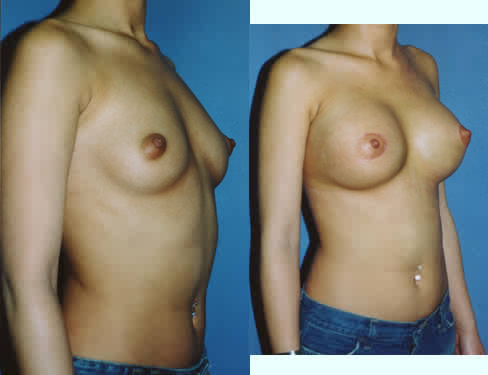 Saline Breast Implants breast enhancement Los Angeles