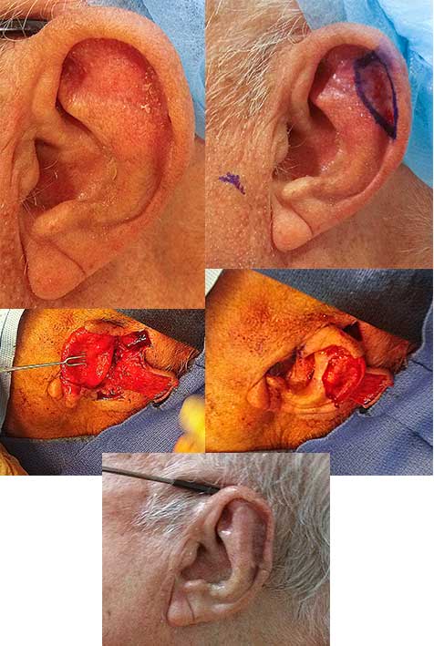 Squamous Cell Carcinoma Ear Los Angeles