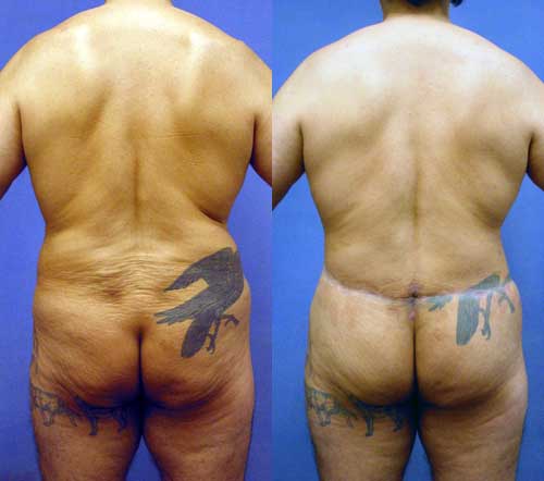 Thigh Buttock Lift - Belt Lipectomy Los Angeles