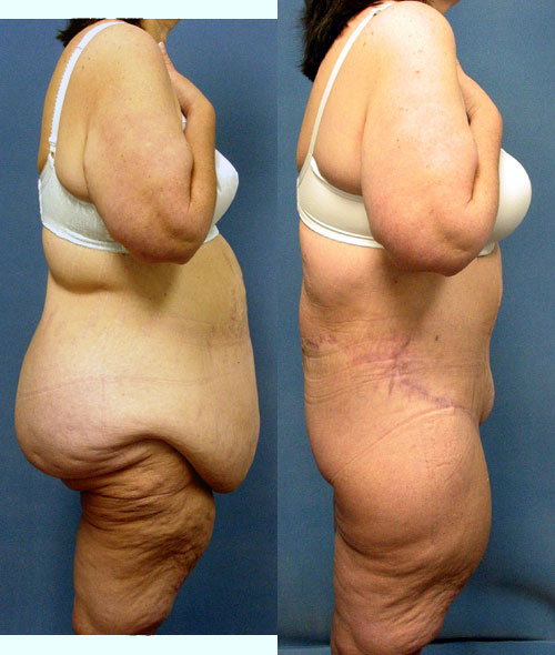 Thigh Buttock Lift - Belt Lipectomy After Massive Weight Loss Los Angeles