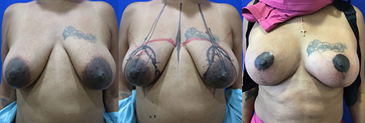 breast lift with breast augmentation